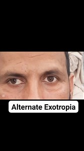 15 degree Alternate Exotropia/Squint #eyecare #healthcare #pathology #medical #surgery #optometrist #opthalmology #eyehealth #lasik #squint #squintsurgery | Ophthalmology Unveiled