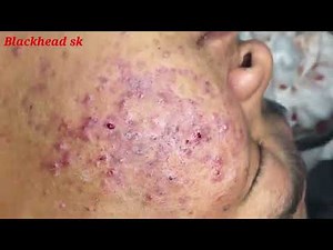 Satisfying and Relaxing with Squeezing Acne, Acne Severe, Hidden Acne #10