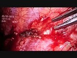 VTS Pleurectomy And Wedge Resection Of Left Upper Lobe • Video • MEDtube.net