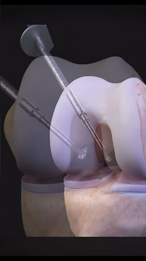 Chirurgie du LCA : Greffe du Semitendineux en Détail – Explication Médicale