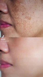 If you're looking to improve the appearance of your skin and get rid...