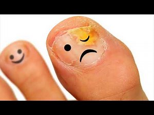 Effective Remedy For Toe Nail Fungus Is Snakeroot Extract- How To Use
