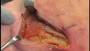 Peroneal Nerve Decompression