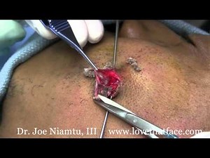 Infected Sebaceous Cyst by Dr. Joe Niamtu, III