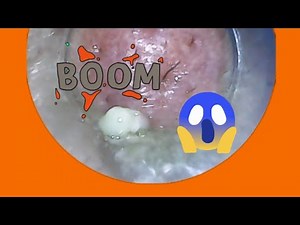 Biggest Acne Explosion Ever!:Big White Pimple? Watch How We Pop It Easily 💥