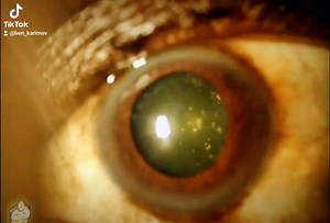 Asteroid Hyalosis | Dr. Benjamin Karimov | Facebook