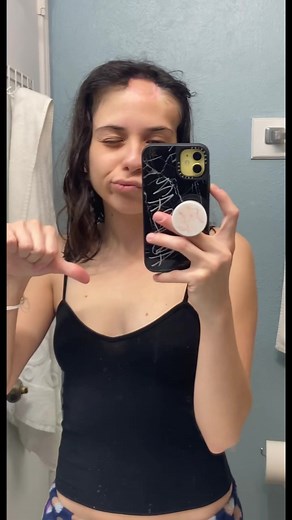 The consequences of rupturing a tissue expander would be deflation that would lead to replacement onto having to start all over with this procedure, and possibly infection. And if it leaks, the salt-water solution (saline) is harmlessly absorbed. ————————————————————— Join me in my reconstruction process from Melanoma (Skin Cancer) 3 months of expanding and I will look like Megamind 👽 Update: 40.5 in each tissue expander ⚠️ @alondra_sierrat Sensitive content ⚠️ Some people may find this video d