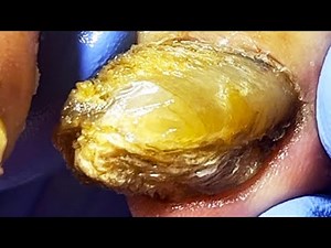 Very Thick Onychomycosis, Cut It Off Step By Step【Pedicure King】