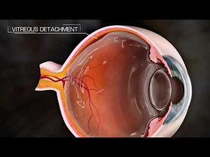 Posterior Vitreous Detachment - PVD