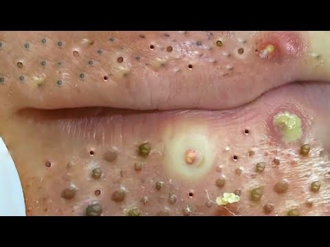 Most Satisfying Video Face Skin Care with Calm Music | Acne Treatment #001042