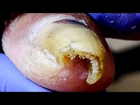 Curled, Hard, Onychomycosis With Severe Internal Deterioration【Pedicure King】