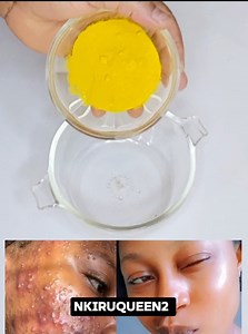HOW TO GET RID OF ACNE SCARS AND DARK MARKS FAST ~ DIY TURMERIC HONEY, FACE MASK! | Nkiruqueen2