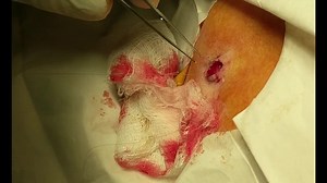 Facial Cyst Removal (GRAPHIC)