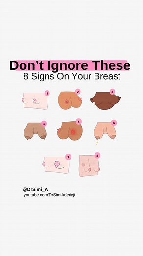 Dr Simi Adedeji on Instagram: "Don’t Ignore These 8 Signs on Your Breast This is one of the most important videos I’ve made, and it’s a message that can really make a difference. Early detection of breast cancer is key – and it all starts with knowing the signs and doing regular self-checks. October is Breast Cancer Awareness Month 🎀 So, take a moment to watch this video, share it, and most importantly, check yourself. 🩷 Tag someone you know and remind them to stay on top of their health. This