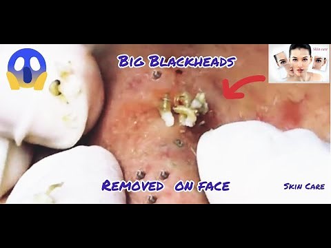 Cystic Acne Extraction This Week, Blackheads Removal #3
