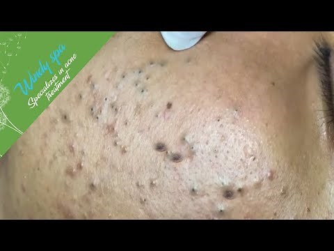 (Acne Treatment for Hung P1) - Make Your Day Relaxing with Windy Spa 6#199