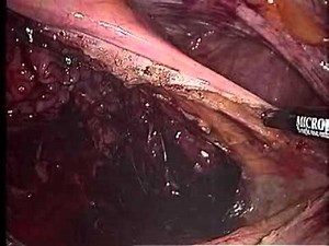 Laparoscopic Rectopexy