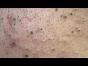 NaSa Spa Reveals POWERFUL Pimple Treatment Secrets!