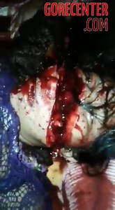 Dying woman with a slashed face and severed hand • GoreCenter