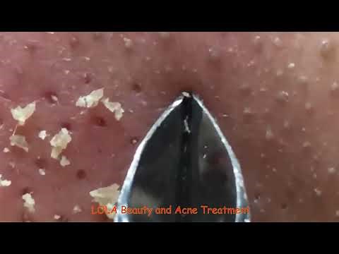 Most Relaxing, Satisfying, Enjoyable; Pluck Acne with Tweezer 01