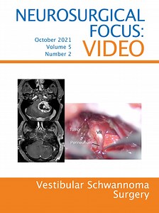 Endoscopic resection through a retrosigmoid transmeatal approach of a large-sized vestibular schwannoma: operative video and technical nuances