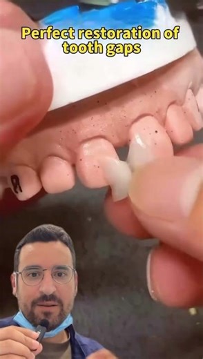🦷 Diastema, charm or dental disorder?