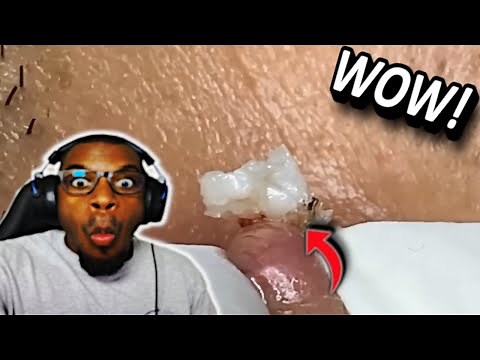 MASSIVE Nose CYST That Will Make Your Jaw DROP!