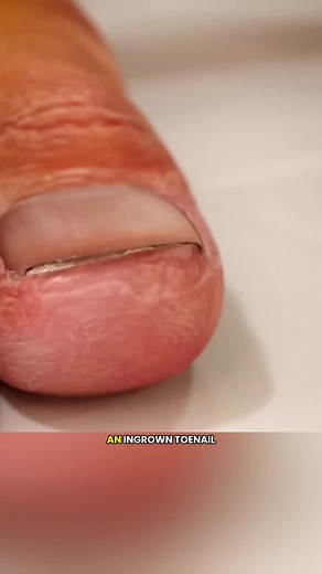 Ingrown Toenail Treatment Surgery 3D Animation Explained