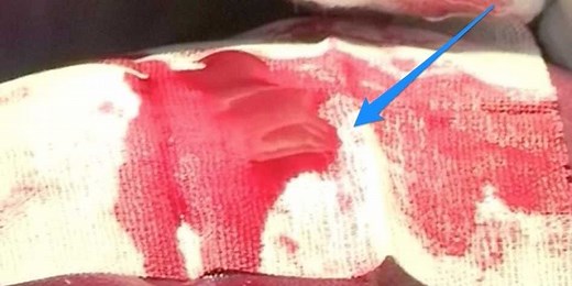 This new bandage could save lives by stopping uncontrollable bleeding for 24 hours