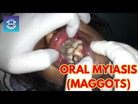 How Maggots Can Invade Your Mouth?🪱🧑🏻‍⚕️ Oral Myiasis