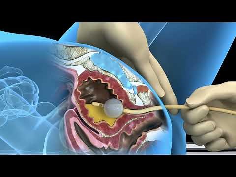 Foley catheter procedure for female bladder drainage - 3D animation