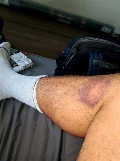 62K views · 327 reactions | Bruise healing up... | Lyfe Jennings | Facebook