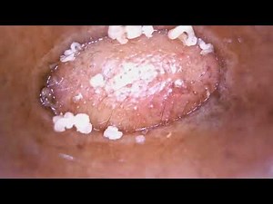 Satisfying Pimple Popping & Blackhead Extraction - 11