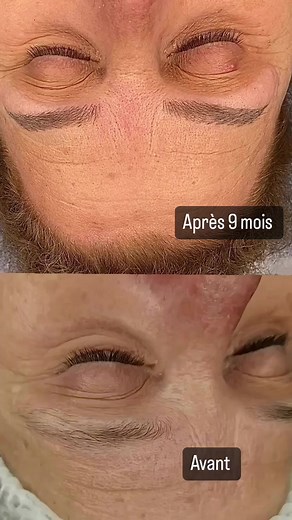 Comment avoir de beaux sourcils ? C'est simple contactez Queen by Nadia ☎️24086775#microblading #microshading #detaouage #lipsshading #ayeliner #microneedling #bbglow #hydrafacial #Tunisie Queen by nadia | Queen by nadia