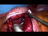Laparoscopic Gastric Bypass - Part 4 • Video • MEDtube.net