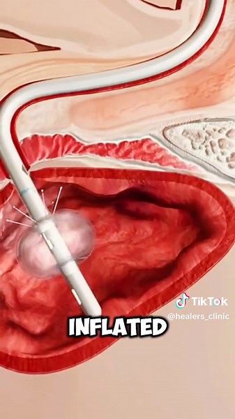 Step-by-Step Male Urinary Catheter Installation Guide