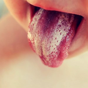 The Candida Cure: 5 Natural Treatments for Getting Rid of It | Yuri Elkaim