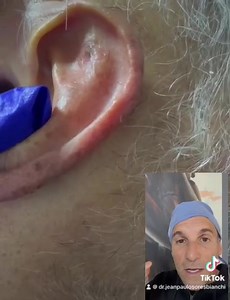 Eliminación de Lentigo con láser | Dr. Jean Paul Osores