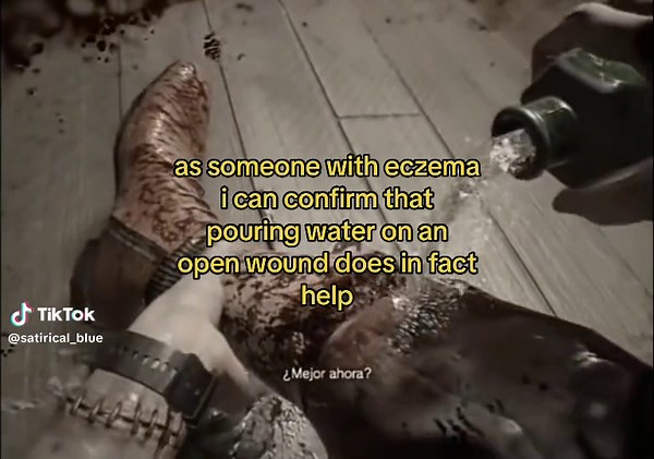 Healing Eczema Wounds: Hot Water Treatment Explained