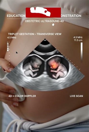 🧐 How does Doppler technology detect triplets? The truth!#miracleoflife #Shorts #viralshorts