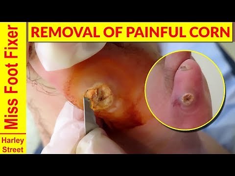REMOVING A PAINFUL AND SOFT CORN FROM FEET (Happy Thanksgiving!!!)