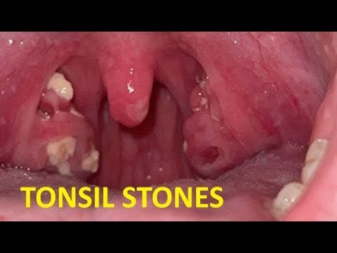 HOW TO GET RID OF TONSIL STONES ULTIMATE TUTORIAL
