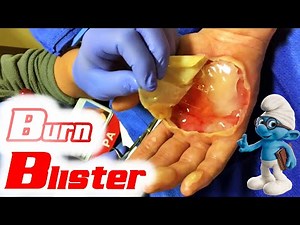 Popping Giant Burn Blister