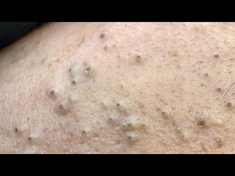 Intense Pore Cleaning Techniques - Acne & Blackhead Removal ASMR Experience