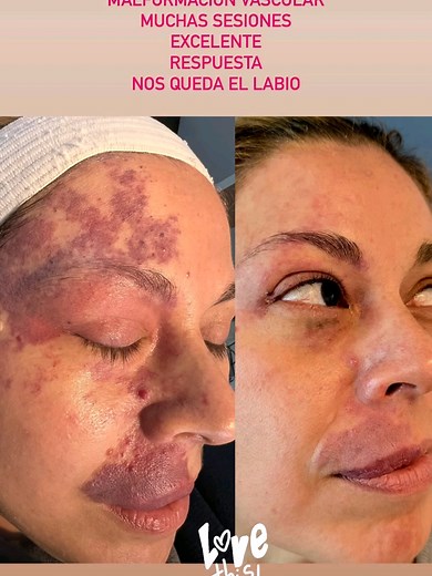 Tratamiento Láser para Malformaciones Vasculares