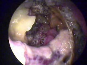 Maggots in nose- Atrophic Rhinitis