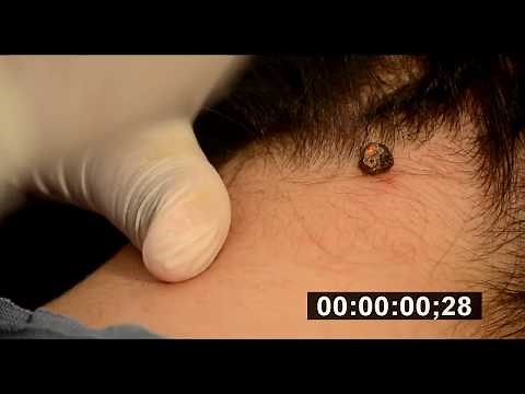 Αφαίρεση Σπίλου (ελιάς) με Laser LIVE - ΠΛΑΣΤΙΚΟΣ ΧΕΙΡΟΥΡΓΟΣ