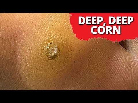 DEEP-Seated Corn Removal On Dancer! (MUST WATCH)