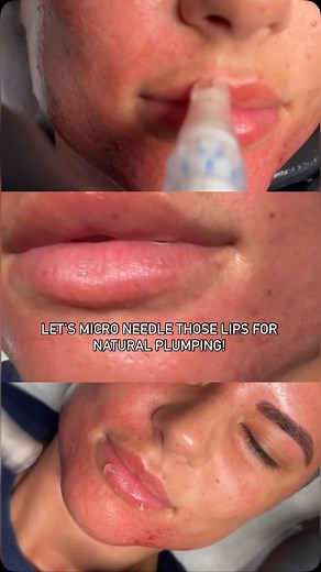 Let’s plump those gorgeous lips 💕 Yep if I can needle it, I’m going to do it… the only place I won’t Micro Needle is your eyeballs 😜 Skin needling, or microneedling, can be used on the lips to improve texture, reduce fine lines, and potentially create a plumper appearance by stimulating collagen production. There are a lot of people out there that are just not into fillers so let’s naturally plump your lips ✨ Book now for your Micro Needling sesh! #lip #plumping #skinpen #skinneedling #microne