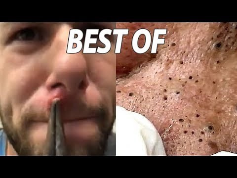 Blackheads Under the Microscope! Pimple Pops & Cystic Acne Removal